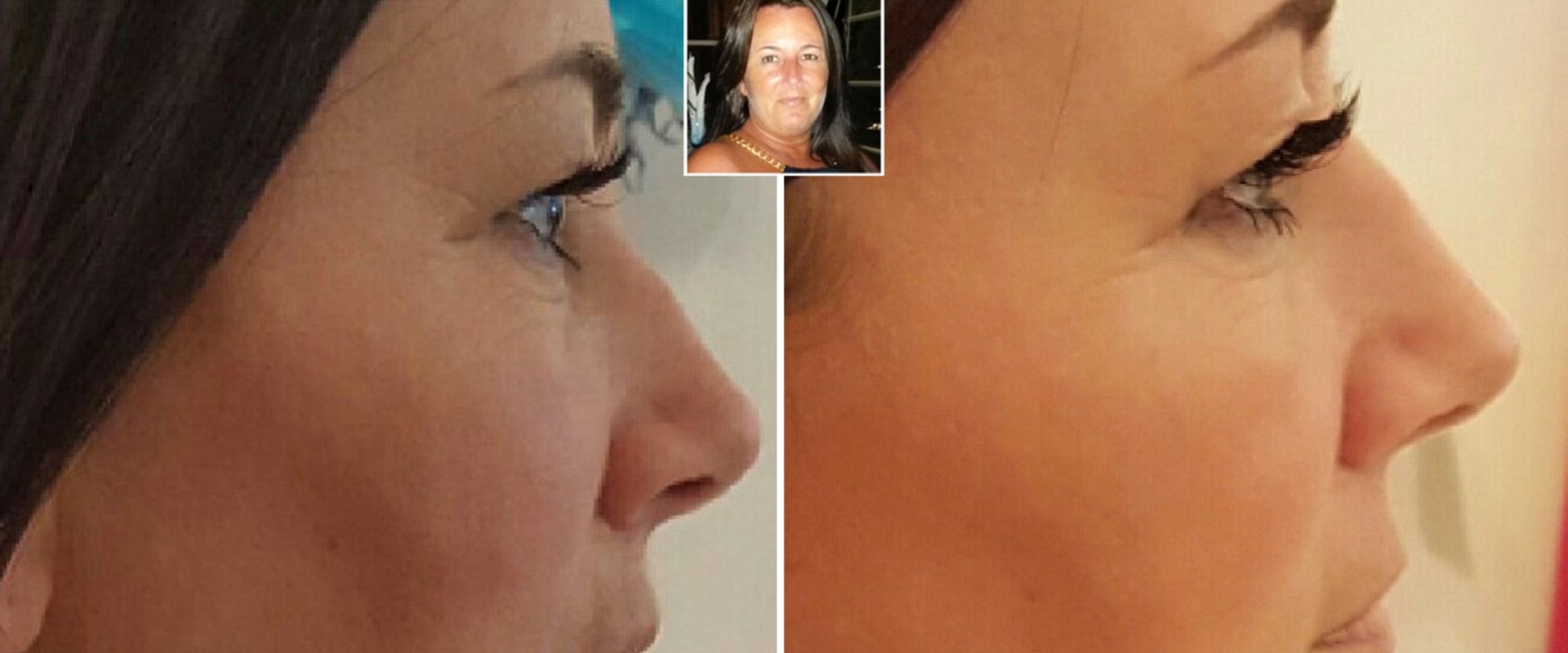 Can Thread Lifts Go Wrong? An Expert's Perspective