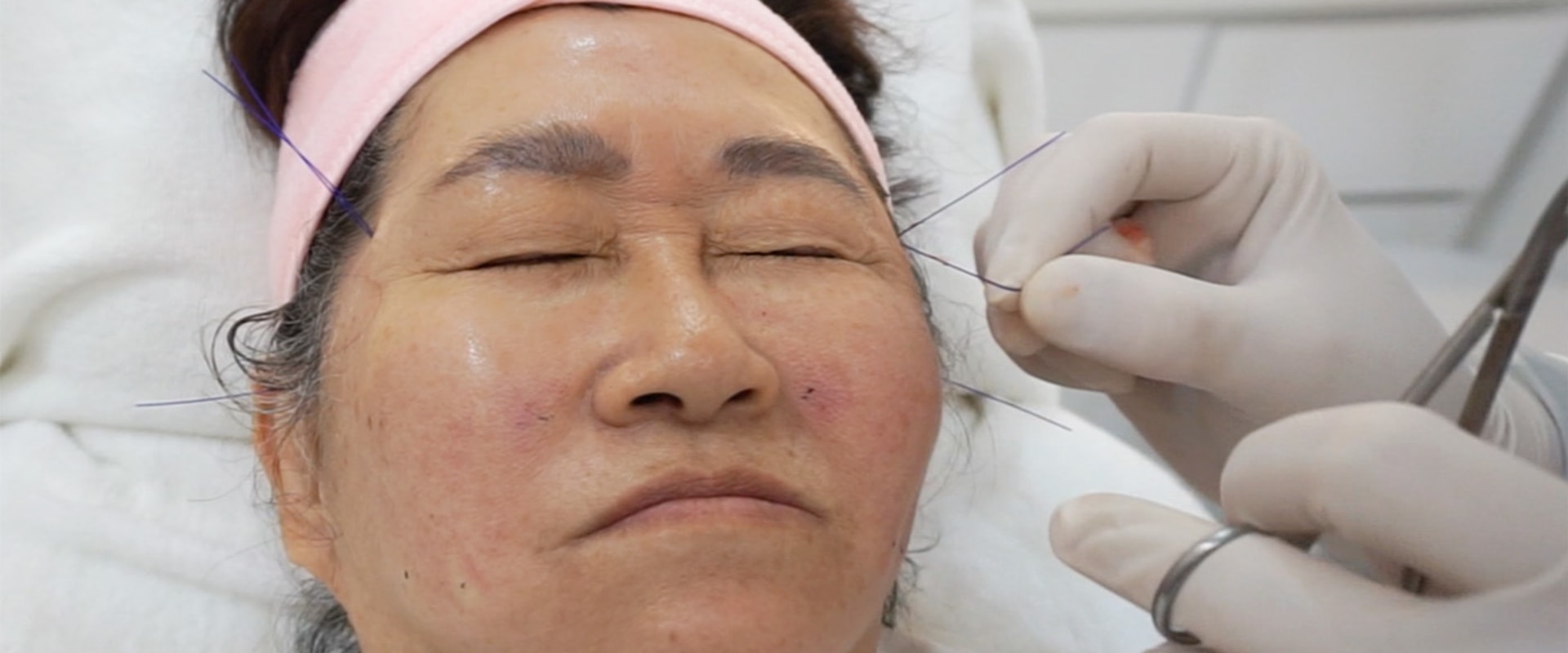 Does the Thread Lift Hurt? An Expert's Perspective