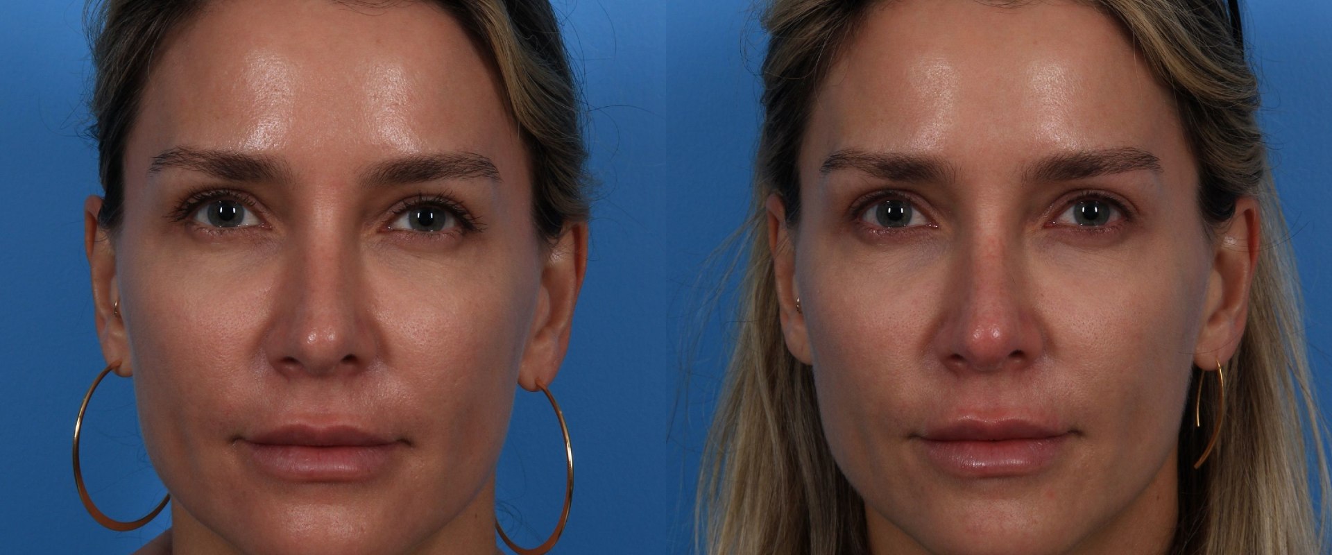 Do Thread Lifts Last Longer Than Fillers?