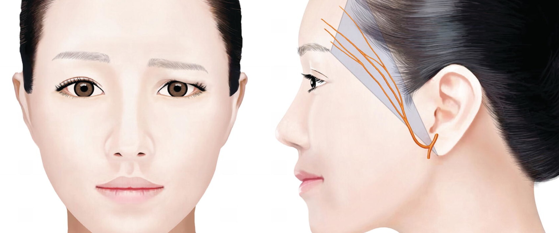 Can Thread Lift Damage Nerves? An Expert's Perspective