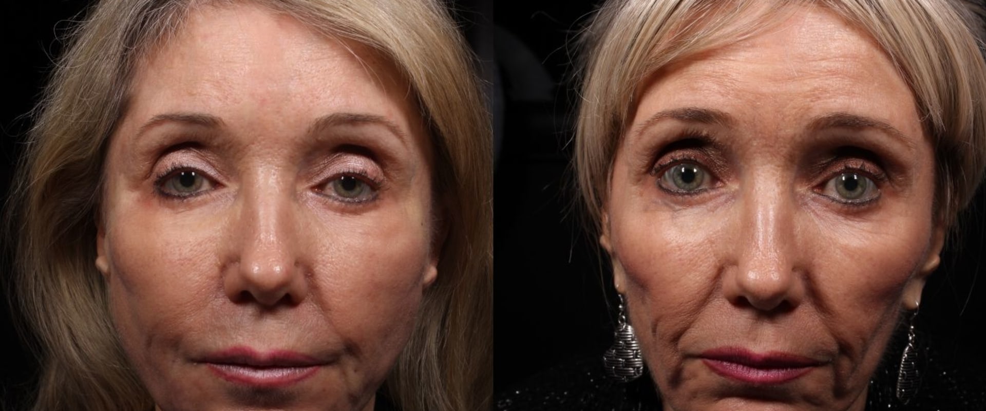 Which Thread Lift is the Best for You?