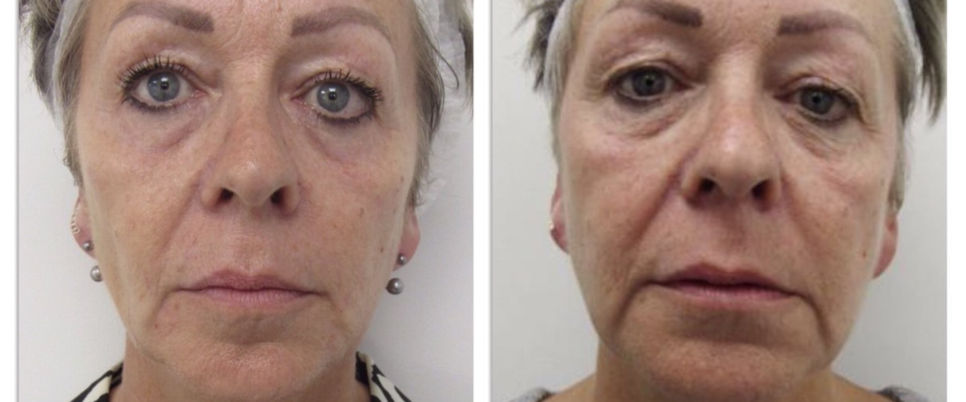 How painful is a thread lift?