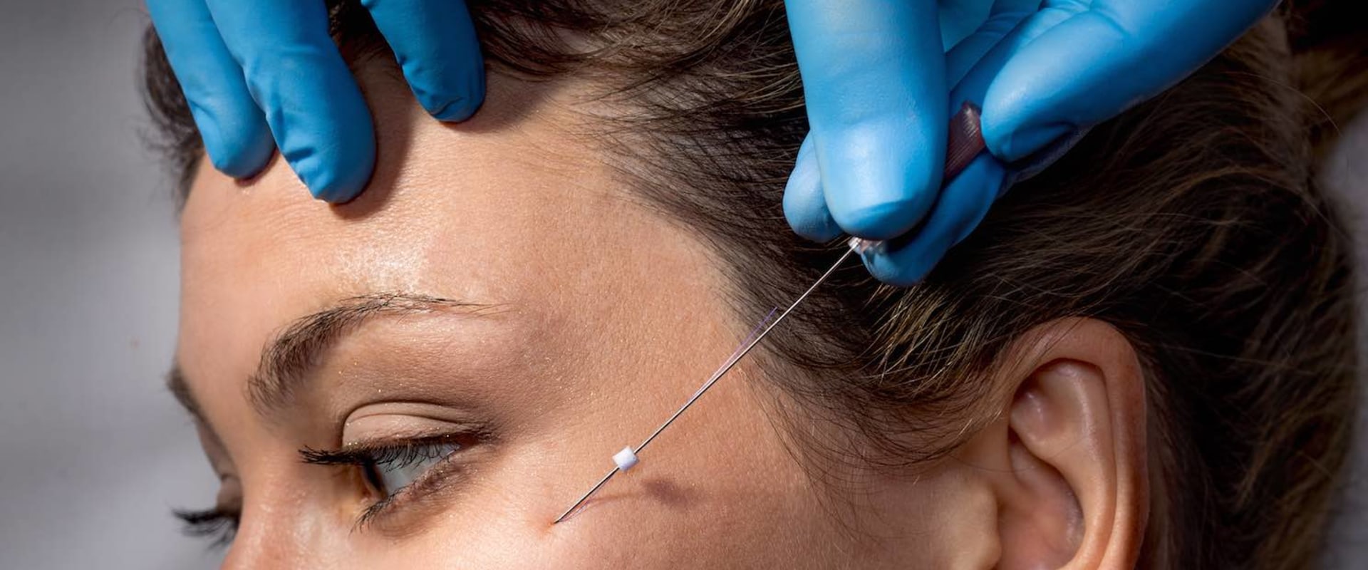 The Benefits of a Thread Lift: A Non-Surgical Facelift