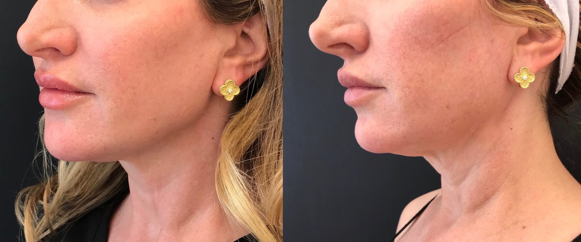 What is a Thread Lift for the Neck?