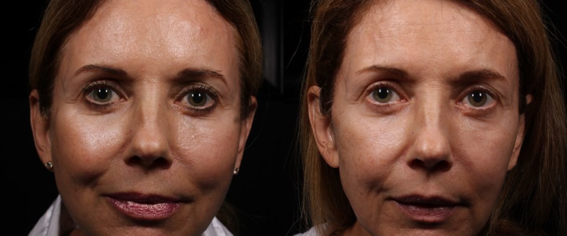 Thread Lifts vs Dermal Fillers: Which is Better for You?