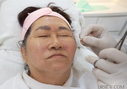 Does the Thread Lift Hurt? An Expert's Perspective