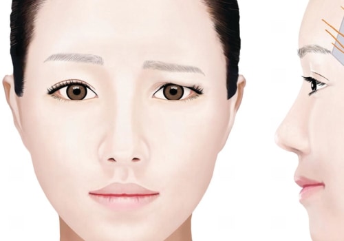 Can Thread Lift Damage Nerves? An Expert's Perspective