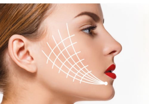 Which Thread Lift Lasts the Longest?