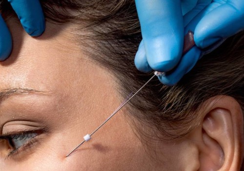 The Benefits of a Thread Lift: A Non-Surgical Facelift