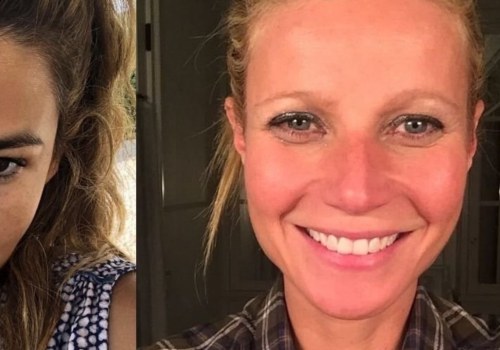 Are Thread Lifts Permanent? An Expert's Perspective