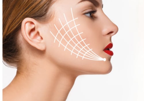 How Long Does a Thread Lift Take?