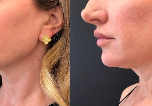 What is a Thread Lift for the Neck?