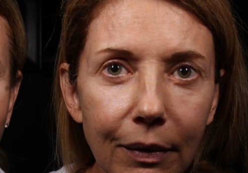Thread Lifts vs Dermal Fillers: Which is Better for You?